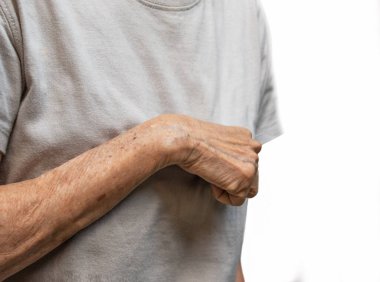 Volkmann contracture in left upper limb of Southeast Asian old  woman. It is a permanent shortening of forearm muscles that gives rise to a clawlike posture of the hand, fingers, and wrist. clipart