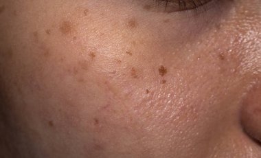 Freckles and brown spots on the oily face of Asian young woman.