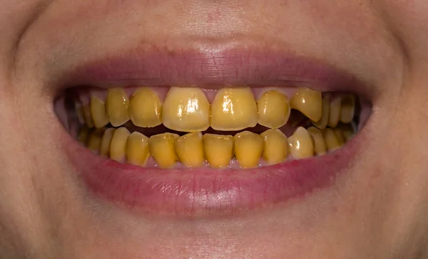 Small teeth with yellow colored tobacco stains. Poor oral hygiene.