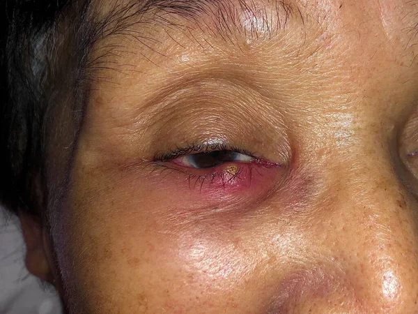 Swollen lower eyelid of Asian elder woman. It can be caused by blepharitis, stye, allergies or chalazion.