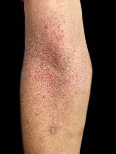 Multiple red spots in cubital fossa showing that Hess test positive. Dengue hemorrhagic fever.
