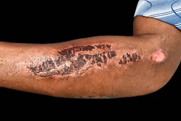 Abrasions healed with scabs at the forearm of Asian male patient.