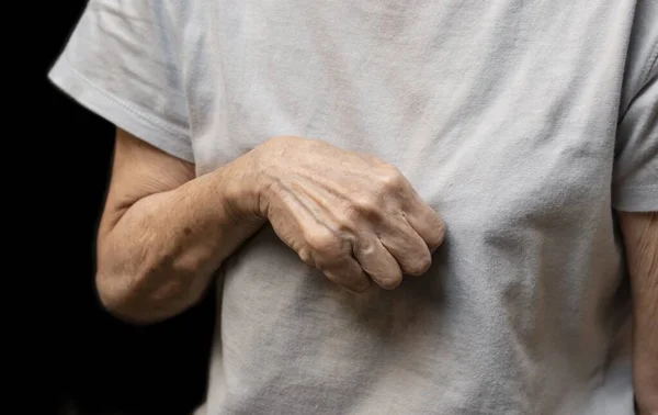 Volkmann contracture in left upper limb of Southeast Asianold  woman. It is a permanent shortening of forearm muscles that gives rise to a clawlike posture of the hand, fingers, and wrist.
