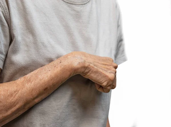 Volkmann contracture in left upper limb of Southeast Asian old  woman. It is a permanent shortening of forearm muscles that gives rise to a clawlike posture of the hand, fingers, and wrist.