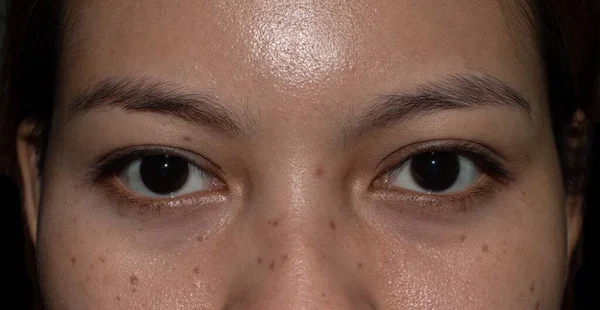 Freckles and brown spots on the oily face of Asian young woman.
