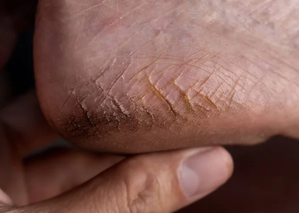 stock image Painful cracked heel of Asian elder woman. Dry foot skin.