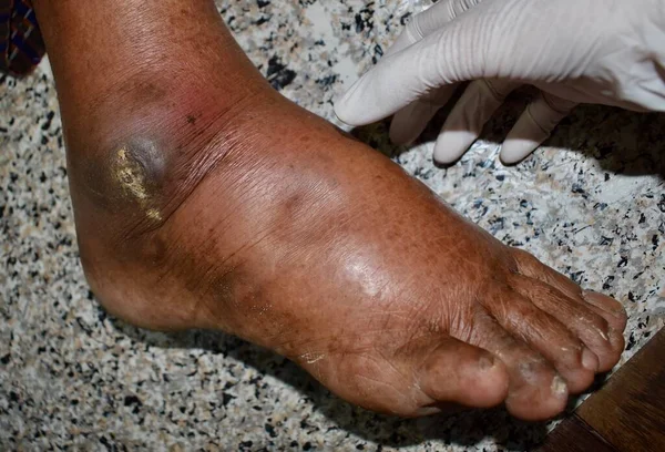 Pitting edema of lower limb. Swollen leg of Asian old man.