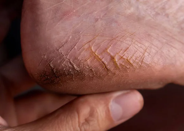 Painful Cracked Heel Asian Elder Woman Dry Foot Skin lizenzfreie Stockfotos