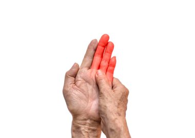 Hand joints inflammation. Concept and idea of rheumatic arthritis, rheumatism, gout, joint swelling or arthralgia. clipart