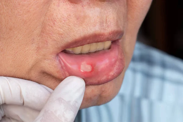 Aphthous Ulcer Canker Sore Stress Ulcer Mouth Asian Male Patient — Stock Photo, Image