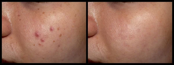 Treatment Acne Vulgaris Black Spots Freckles Oily Face Southeast Asian — Stock Photo, Image
