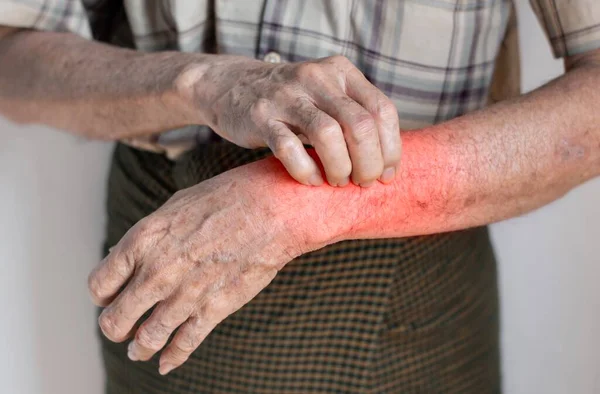 Asian elder man scratching his forearm. Concept of itchy skin diseases such as scabies, fungal infection, eczema, psoriasis, rash, allergy, etc.