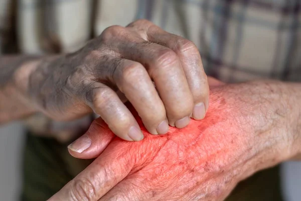 Asian elder man scratching his hand. Concept of itchy skin diseases such as scabies, fungal infection, eczema, psoriasis, rash, allergy, etc.