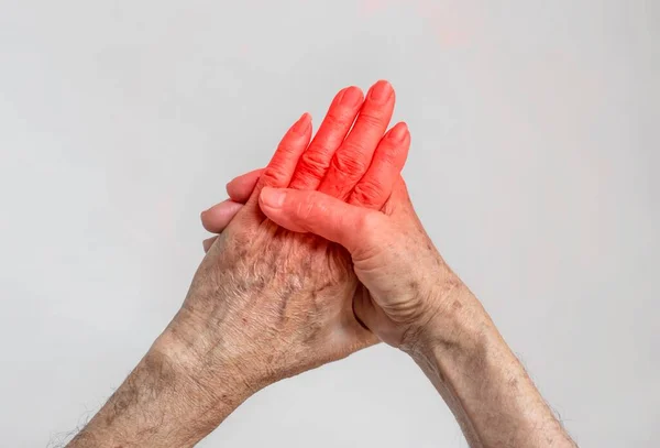 Entzündung Der Handgelenke Konzept Und Idee Der Rheumatischen Arthritis Rheuma — Stockfoto