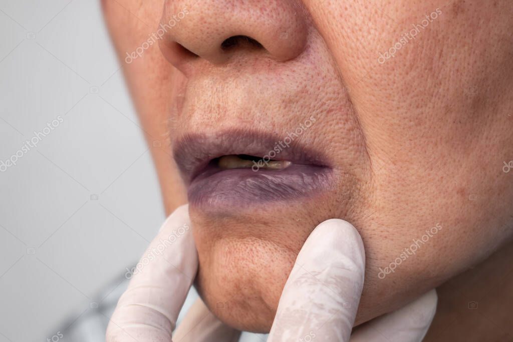 Decoloración azulada de los labios. Cianosis central en anciano asiático con cardiopatía