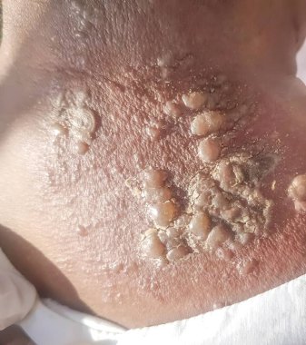 Ensesinde uçuk enfeksiyonu var. Küçük ve acılı Vesicles.