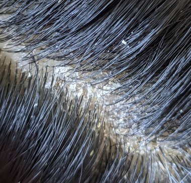 Dandruff flakes between hair on the scalp. Closeup view clipart