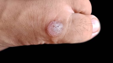 Ayak başparmağındaki nasır ya da nasır, siyah arka planda izole edilmiş. 