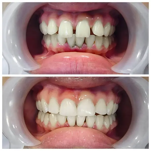 Ön dişler ve kesici dişler arasındaki büyük boşluk için önce ve sonra, diastema.