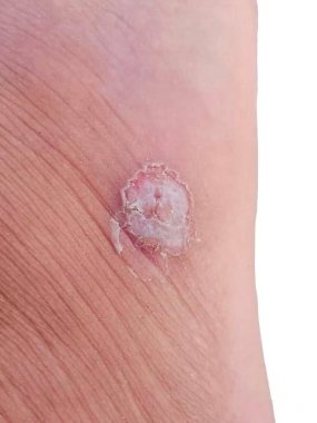 Deride, kalınlaşmış, kabataslak ve yükseltilmiş bir alanla karakterize edilen mısırın yakın çekimi.