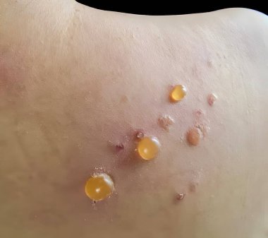 Çoklu sıvı ile yakın çekim cilt kabarcıkları Boğa pemphigoid karakteristiği, nadir bir cilt durumu