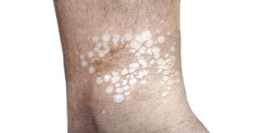 Closeup of a leg with white patches characteristic of tinea versicolor, a fungal skin infection. clipart