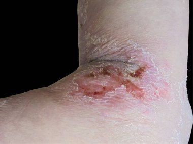 Ayağındaki egzama kırmızı pullu lekeler ve çatlak deriyle karakterize edilmiş. Siyah üzerine izole edilmiş.