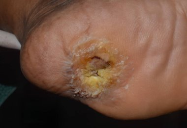 Asyalı bir hastanın ayağında diyabet ve ayak ülseri