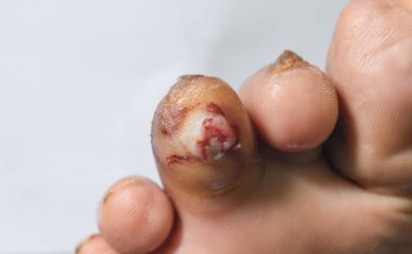 Bir hastanın ayak parmağında ayak ülseri var..