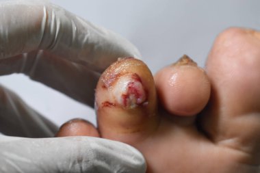 Bir hastanın ayak parmağında ayak ülseri var..