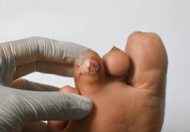 Bir hastanın ayak parmağında ayak ülseri var..