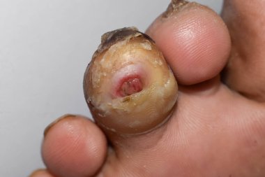 Diabetes foot ulcer in the toe of Asian patient. clipart