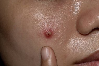 Asyalı hastanın yüzünde kistik sivilce var. Büyük kabarcık..