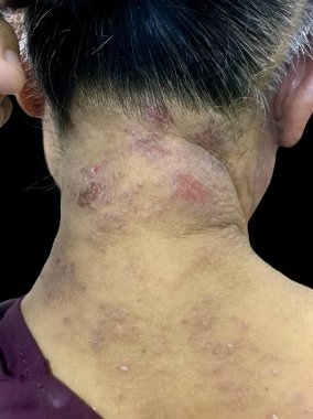 Güneydoğu Asyalı Myanmar kadın hastasının kafa derisinde seborrheic dermatit veya mantar derisi enfeksiyonu.