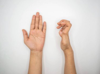 Asyalı genç bir kadının sağ elinde Volkmann kasılması. El, el, parmak ve bilek pençe benzeri bir duruş oluşturan ön kol kaslarının sürekli kısaltılmasıdır..