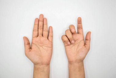 Asyalı genç bir kadının normal eliyle karşılaştırıldığında Ulnar el pençe atıyor. Kol kemiği zedelenmesinden kaynaklanan gelişmeler lumbrikallerin felç olmasına neden olur..