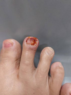 Şiddetli bir paronychia vakası olan bir ayak parmağı, tırnağın yanında şişkinlik ve kızarıklık var.