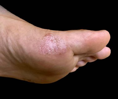 Kuru, pullu bir egzama bandına yakın, ayağının yüzeyinde renk değişimi var.