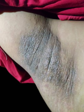 Closeup of a hyperpigmented, thickened, and velvety patch of skin in the underarm, characteristic of acanthosis nigricans. clipart