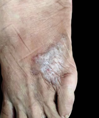 İnsan derisinde renk bozulması olan egzama bandına yakın çekim..