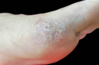 Kuru, pullu egzama bandı. Ayağında renk değişimi var..