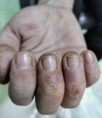 Parmaklarda iltihaplanmış, çatlamış ve deri yüzülmüş. Kronik dermatit belirtileri var..