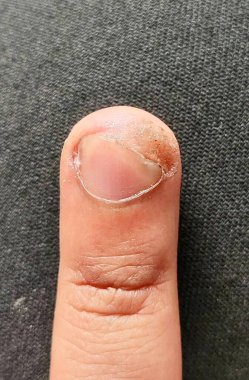 Mantar tırnağı enfeksiyonunu gösteren bir parmak. Renk değişimi, soyulma ve tırnak çevresinde kalınlaşmış deri..