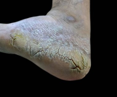 İnsan Ayağının Kurumuş, Çatlamış Derisinin Yakınlaştırılması.