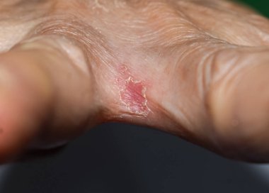 Mantar enfeksiyonunu gösteren kırmızı, iltihaplı bir bant içeren tinea manuumdan etkilenmiş bir el..