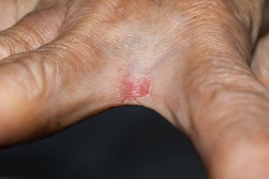 Tinea manuum 'dan etkilenmiş bir el. Kırmızı, iltihaplı bir yama, mantar enfeksiyonuna işaret ediyor..