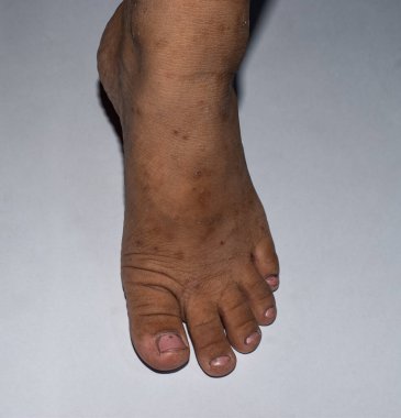 Uyuz bir çocuk ayağı, kırmızı, tahriş olmuş deriyi gösteriyor. Küçük şişlikler ve lezyonlar mayt istilasından kaynaklanıyor..