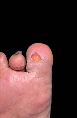 Ayak baş parmağındaki diyabetik ülserin yakın plan görüntüsü, çiğ ve iltihaplı deriyi ön plana çıkarıyor..