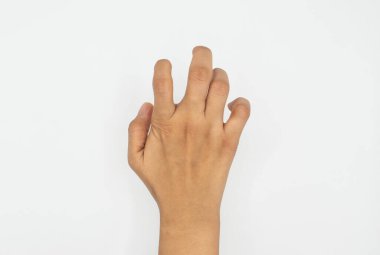 Bir insan eli, ön kol kası hasarı ve sinir hasarından kaynaklanan Volkmann iskemik kasılmasından kaynaklanan pençe benzeri duruş ve parmak esnekliği bozukluğunu gösterir..