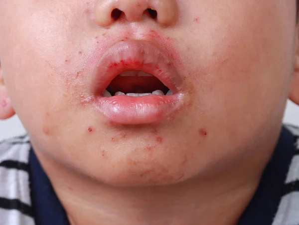 Zbliżenie Zapalenie Skóry Stopa Dłoni Wysypka Czerwone Guzki Ustach Choroba — Zdjęcie stockowe